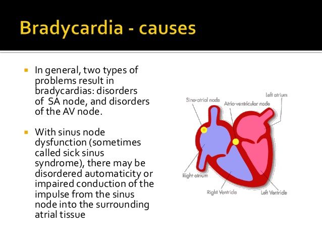 pauses bradycardia-7-638